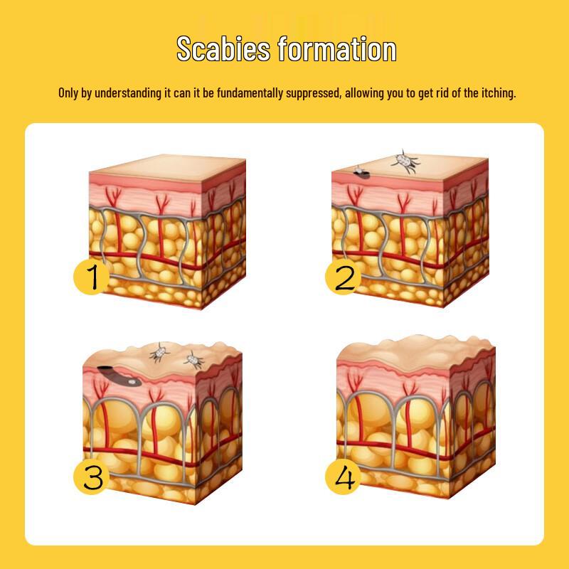 Zhou Langzhong 10% Sulfur Anti-Itch Cream