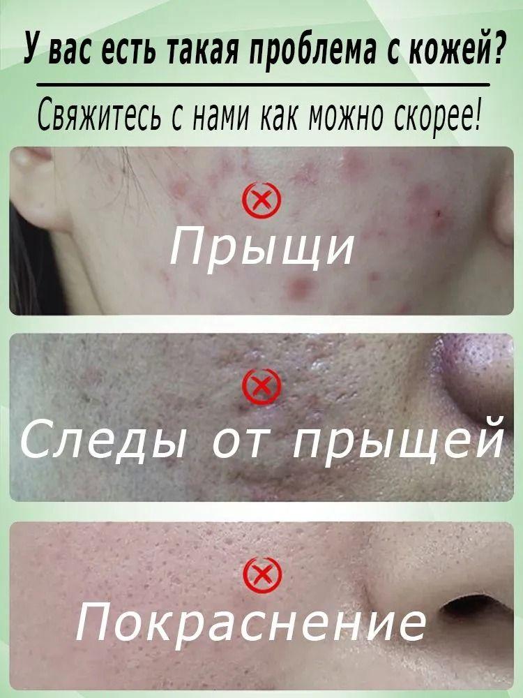 Cream for facial inflammation, acne and blackheads, for oily and problem skin, suitable for teenagers and adults, 15 g