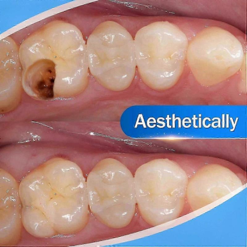 Starker Zahnzement zur Zahnreparatur, Kariesfüllung & Restauration, Harz-Zahnreparaturset für die dentale Restauration