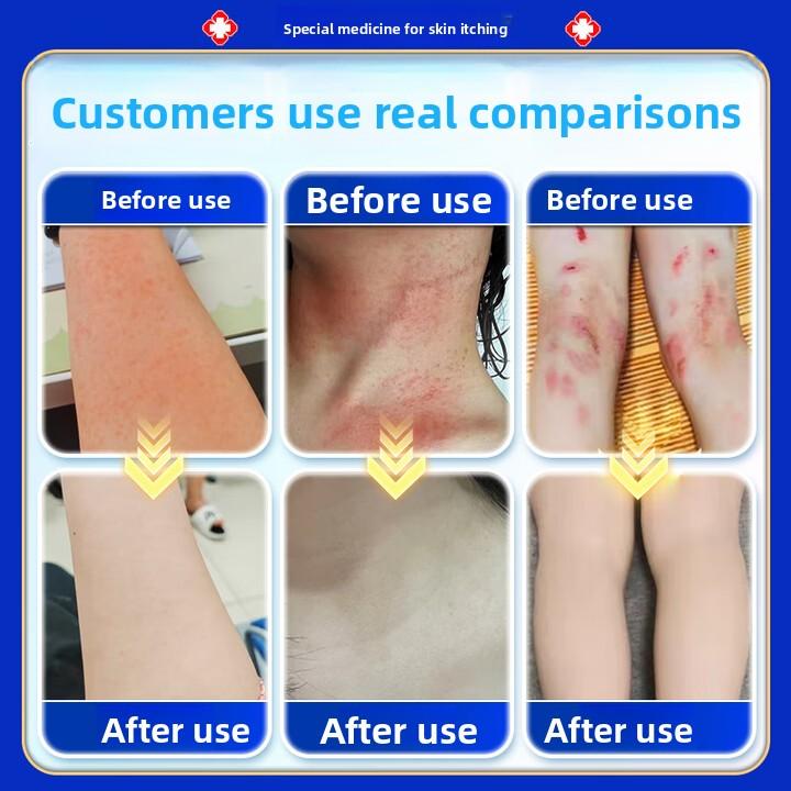 Anti-Itch Cream 50g Large Size, Fast Relief for Eczema, Fungal, Dermatitis & Skin Rashes, Antiseptic