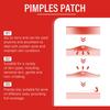 EELHOE Acne Patches with Salicylic Acid: Gentle Cleanse, Moisturize, and Soothe for Clear Skin. Portable Acne Care Solution.