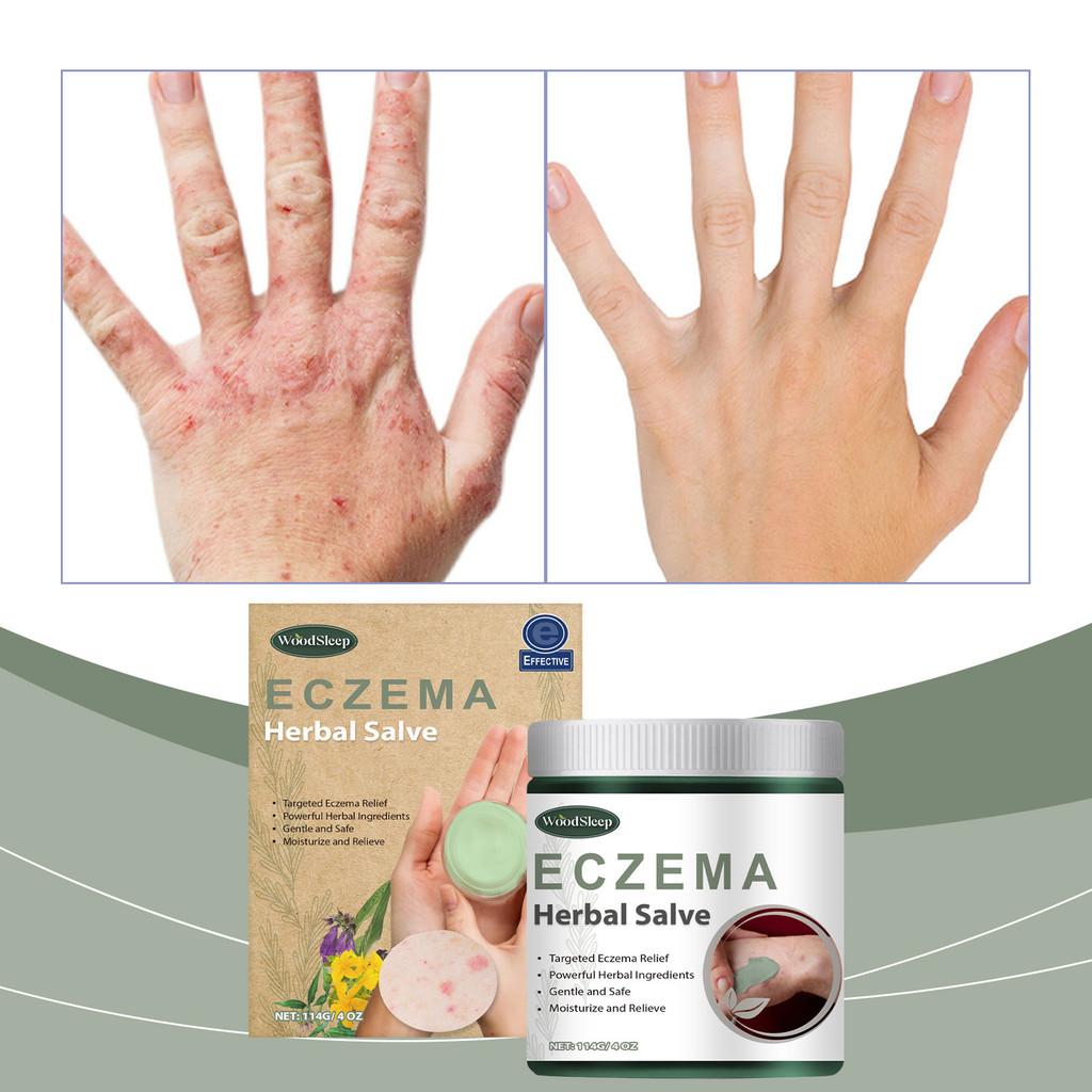 Woodsleep Herbal Cream Natural Formula For Soothing Skin Redness And Bumps