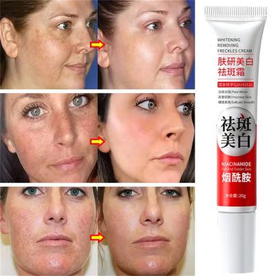 Starke Fleckenentfernungs-Aufhellcreme Hellt die Haut schnell auf Eliminiert Melanin-Pigmentierung Melasma Dunkle Flecken