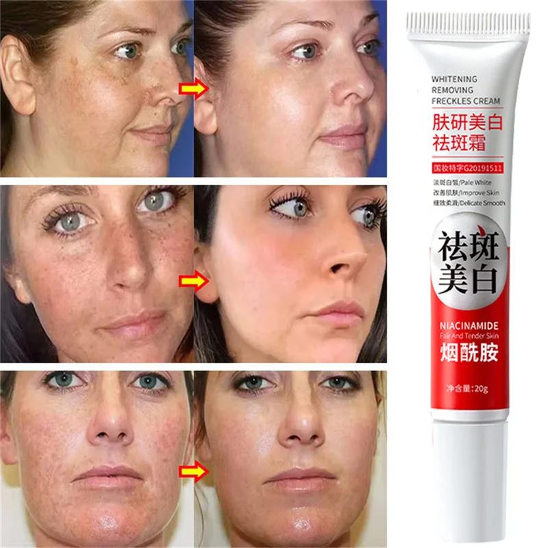 Powerful Spot-Removing Whiten Cream Brighten Skin Fast Eliminates Melanin Pigmentation Melasma Dark Spots