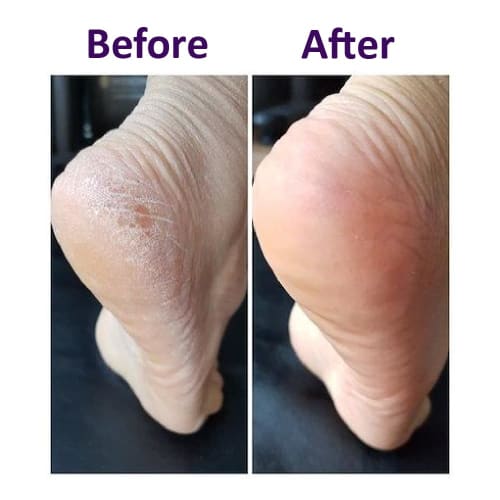 KaKaTo LaBo by baren Heel Labo Set: Heel Labo Essence & Heel Brush Set, Foot Softener, AT-HOME, Korean Salon, At-Home Foot Care, Dry Skin, Eraser