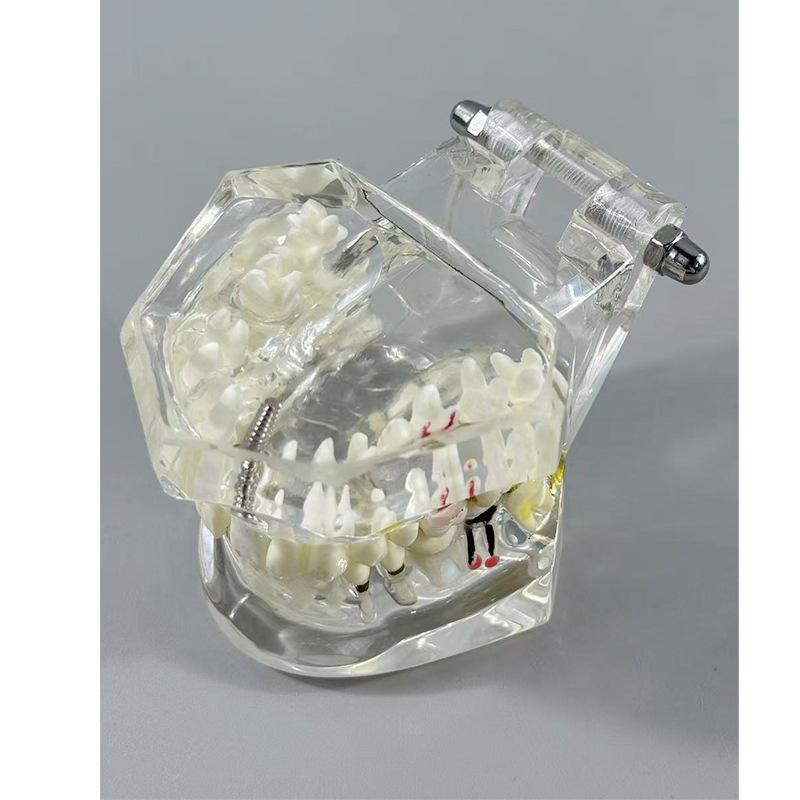 Прозора Знімна Повна Модель Щелепи з М'якими Яснами та Зубами для Підготовки до Імплантації