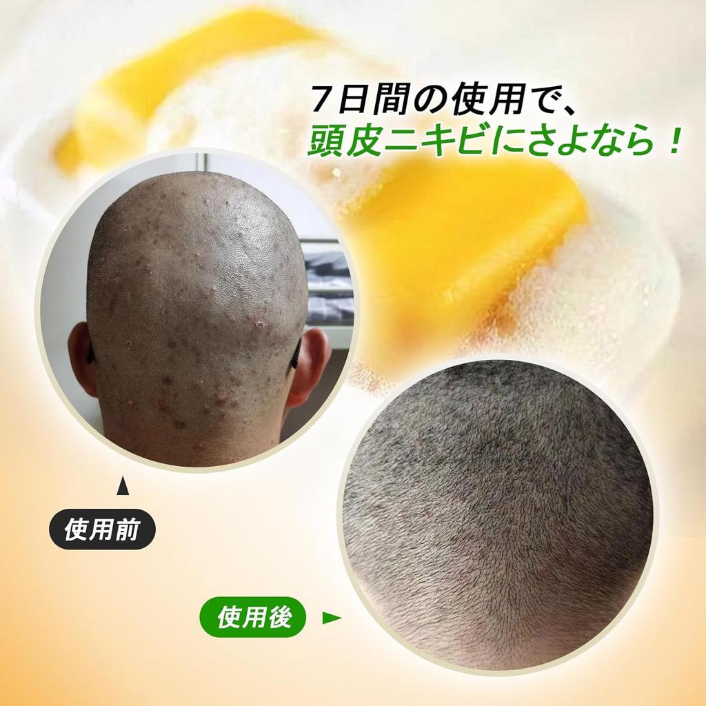 Savon Soufré Visage Savon Soufré Shanghai Contrôle du Sébum Adoucissant Pores Obstrués Barre de Savon Sûre Faible Irritation Pour Peau Mixte 130g Blanchissant