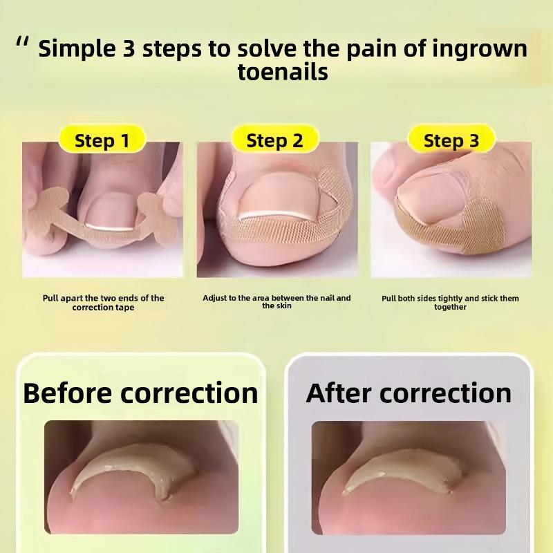 The Nail Improvement Tool for The Nail Groove - Isolates The Toenail, Allows for The Growth of The Nail, and Fills In The Area with A Padding Pad.