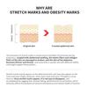 Removal Acne Scar Stretch Marks Cream Fat Scar  Treatment