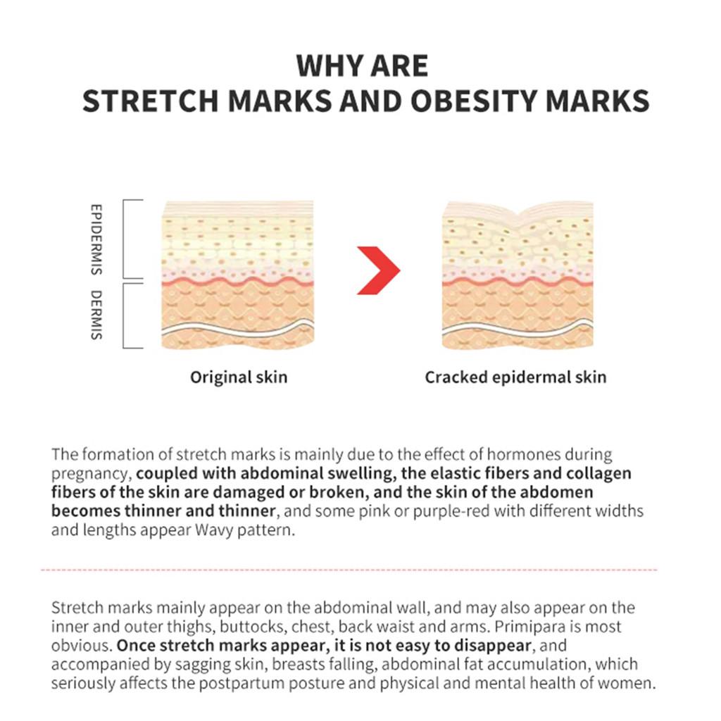 Removal Acne Scar Stretch Marks Cream Fat Scar  Treatment