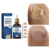 Ingrown Toenail Treatment. Ingrown Nail Repair Serum