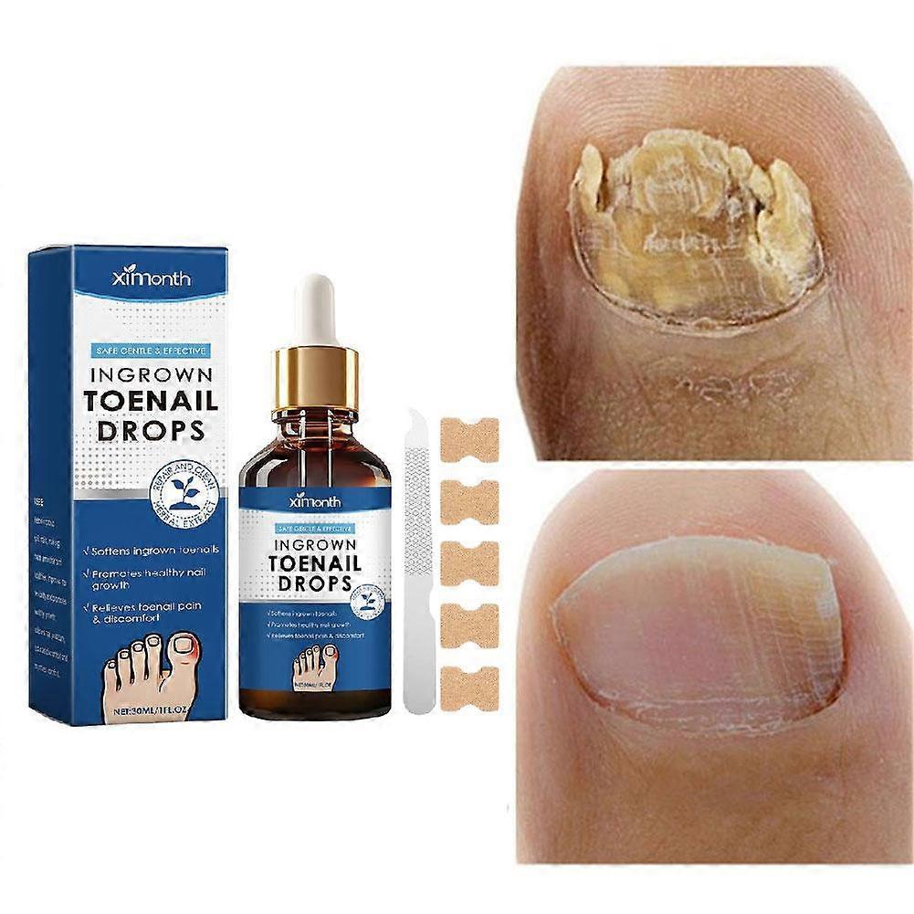 Ingrown Toenail Treatment. Ingrown Nail Repair Serum