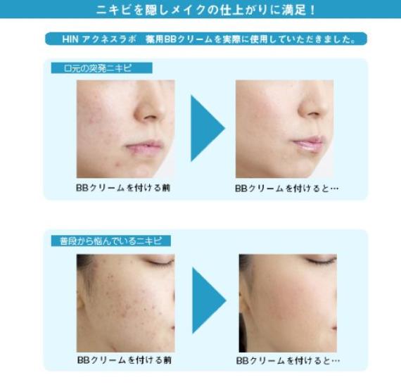 HIN Acnes Labo Medicated BB Cream 35g (Light Beige)