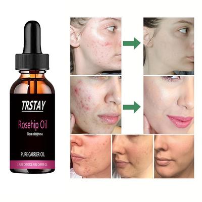 Tca Aid Skin Peel Kyselina trichloroctová 20% Skin Peeling Péče o pleť Péče o pleť Sérum na pleť
