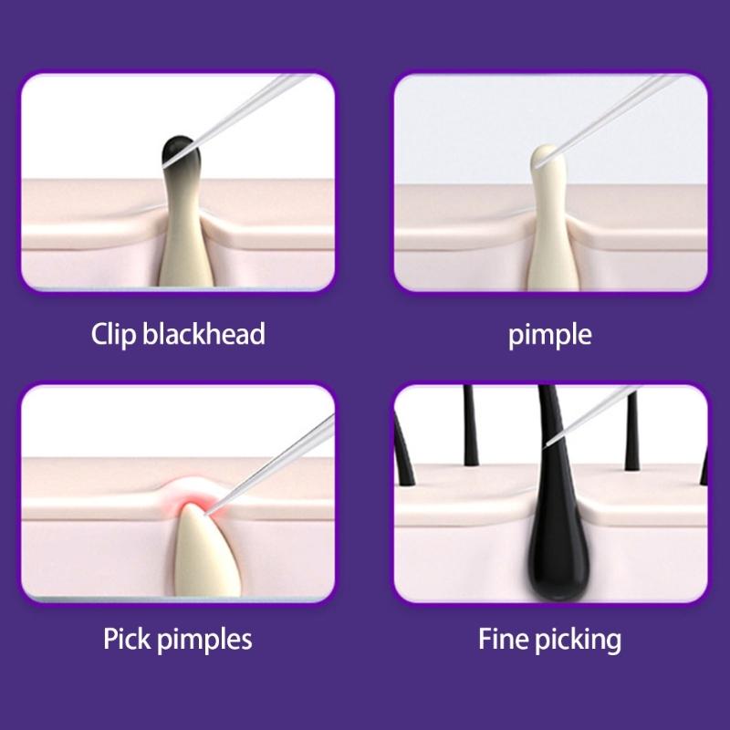 3 Pcs Facials Blackhead Remover Tweezers Extractor Acne Removal Pimple Popper Tool Kits Blackheads Tweezers