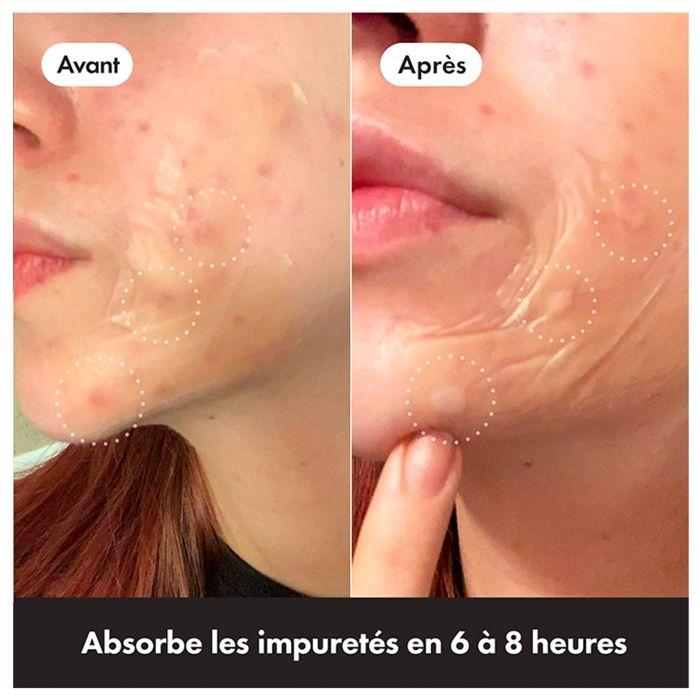 Patchs Anti-Acné - Hero - Mighty Patch - 10 Patchs - Hydrocolloïdes - Hypoallergénique