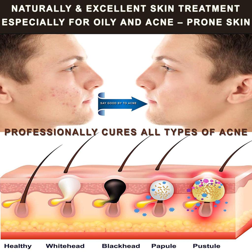 Amueroz Anti Acne Face Serum – PACK OF TWO | Deep Acne Repair Serum with Tea Tree, Chamomile, Calendula, Thymol & Licorice Extract | Anti Blemish