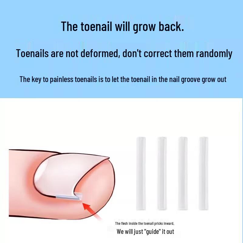 Набор для коррекции вросшего ногтя на ноге Miaomei