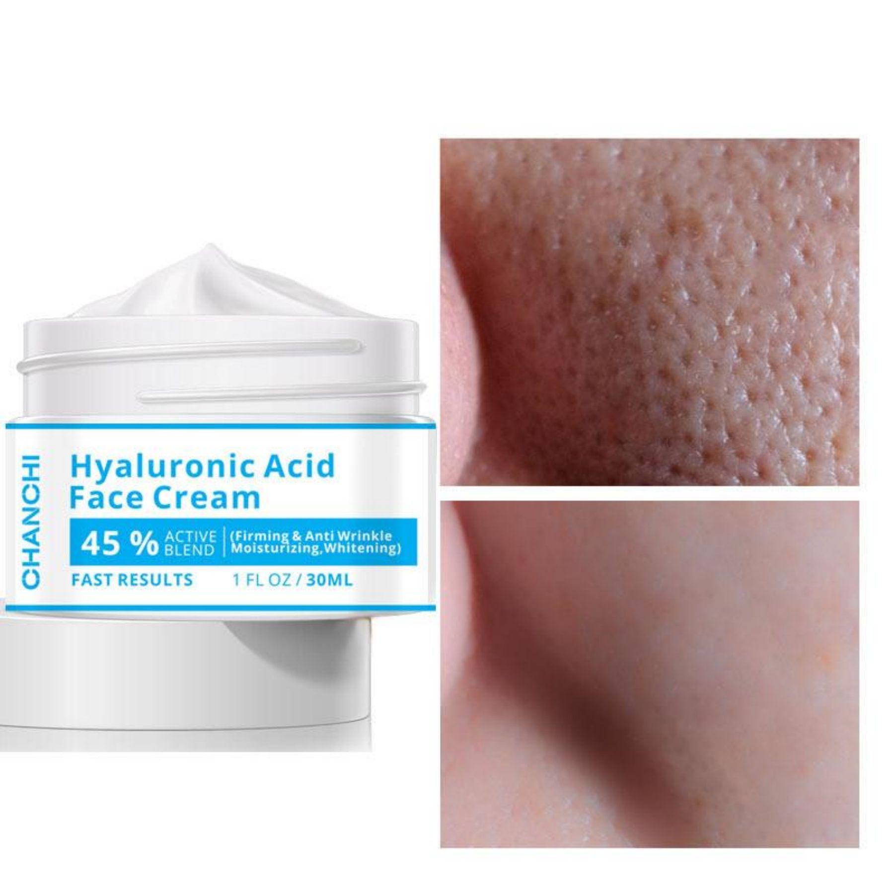 

hyaluronic acid cream to lighten acne marks skin care firming skin tightening cream