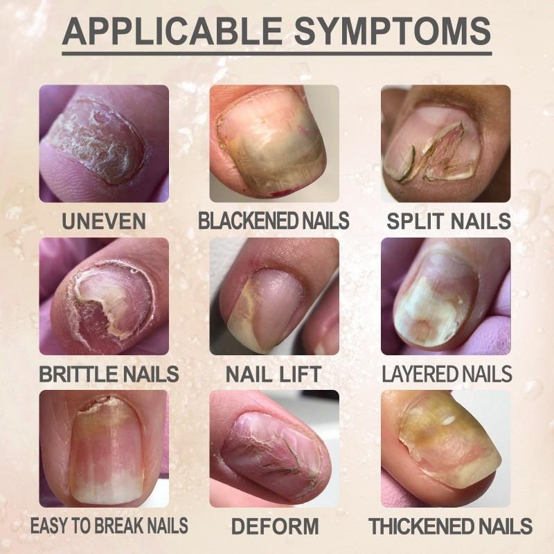 Revitalizing Ouhoe 7 Day Nail Repair Essence For Healthy Strong Nails And Toenails