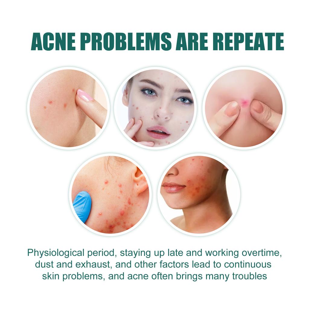 EELHOE Star Acne Patch Gentle Cleansing Lighten Acne Soothing Skin Acne Patch Facial Cleansing Treatment