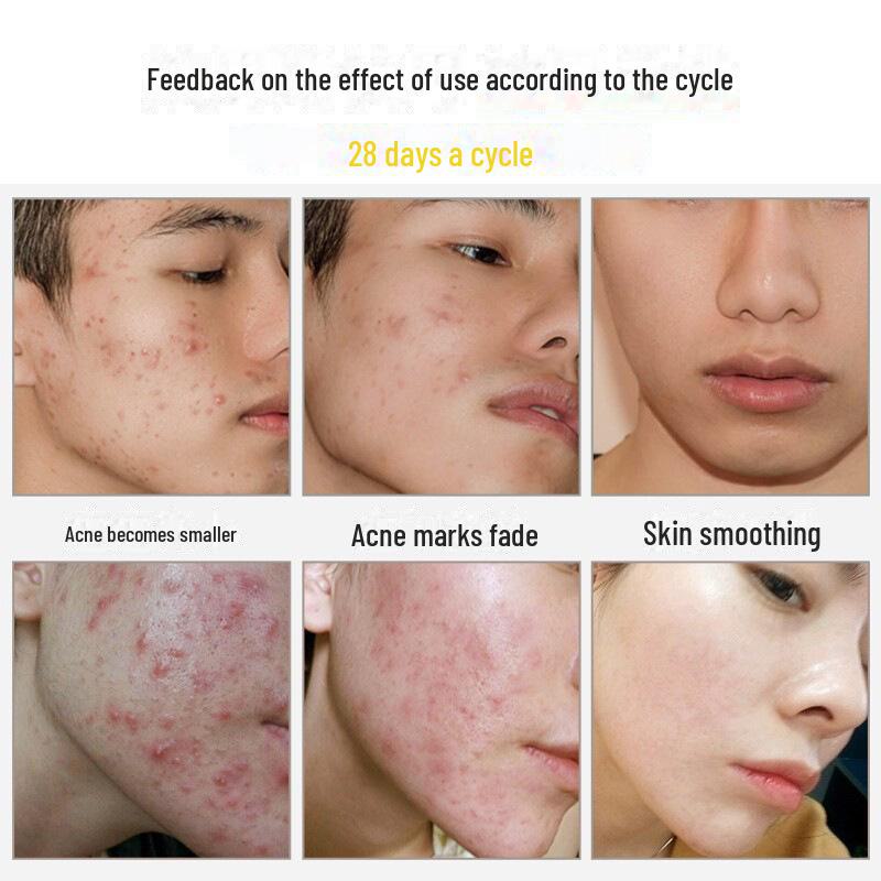 Herbal Acne Cream: Fade Marks, Repair Pits & Pimples, Powerful & Genuine Solution