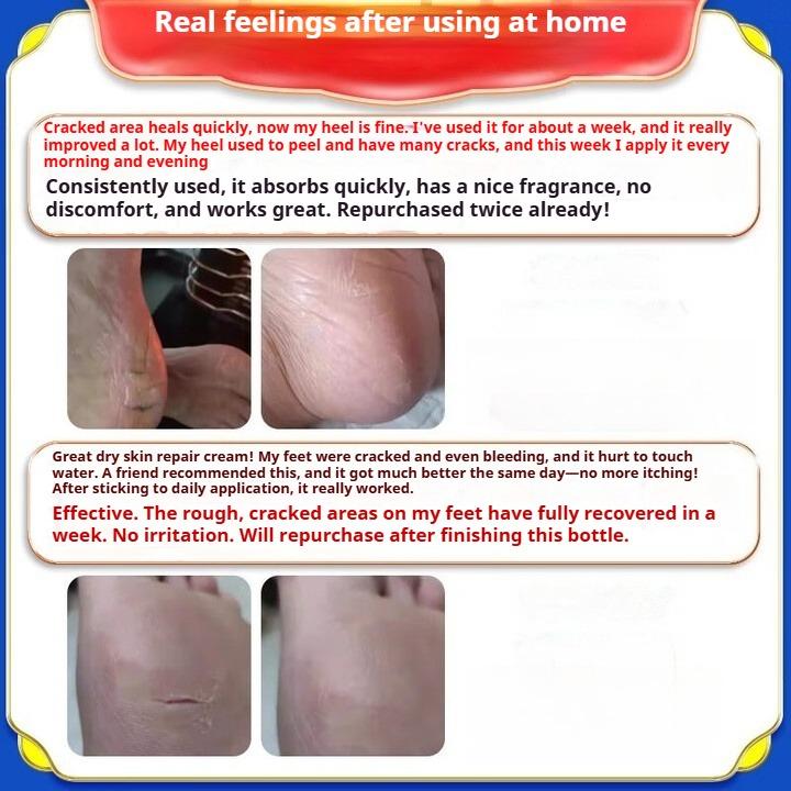 Cracked Feet Cream, Cracked Heels, Cracked Cracks, Fungal Infections, Special Cream for Frostbite Cracks In Hands and Feet