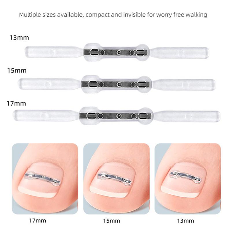 Ingrown Toenail Corrector Tools Pedicure Recover Embed Toe Nail Treatment Professional Ingrown Toenail Straightening Clip Brace