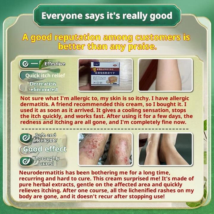 Urticaria ointment anti-allergic and anti-itching cream