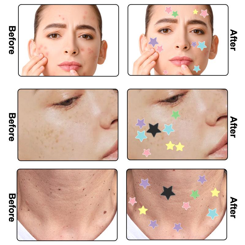 72/80 Pièces Coloré Mignon Étoile Forme de Cœur Autocollant Traitement Acné Invisible Couvre Acné Patch Bouton Soin de la Peau