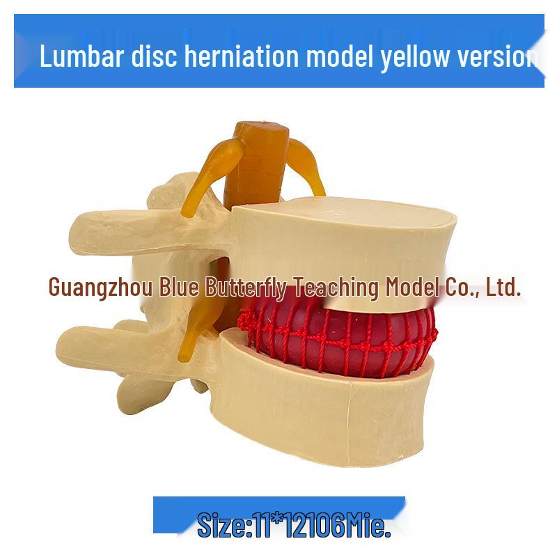Genuine Lumbar Spine Protrusion & Vertebra Pathology Model