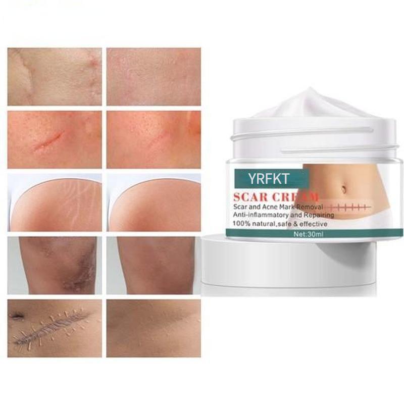 Krém pro péči o pleť po akné na jizvách hluboce proniká do kutikuly