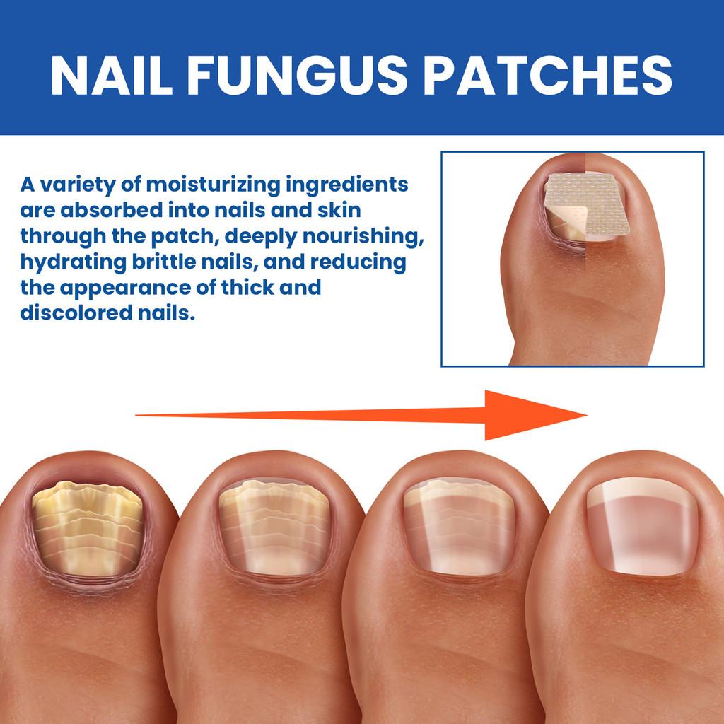 Patchs Réparateurs pour Ongles d'Orteil Ximonth Pour Soin Nourrissant et Adoucissant des Ongles Fongiques