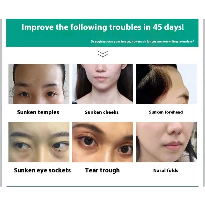 Fengying Elasmizing Essence Fills Apple Muscle Fengface Essence Huafeng Forehead Tear Groove Lifting