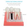 ANNWAN Dental Implant Model 4 Times Removable Analysis Crown Bridge Demonstration Teeth Model for Class Education and Studying Teeth Model