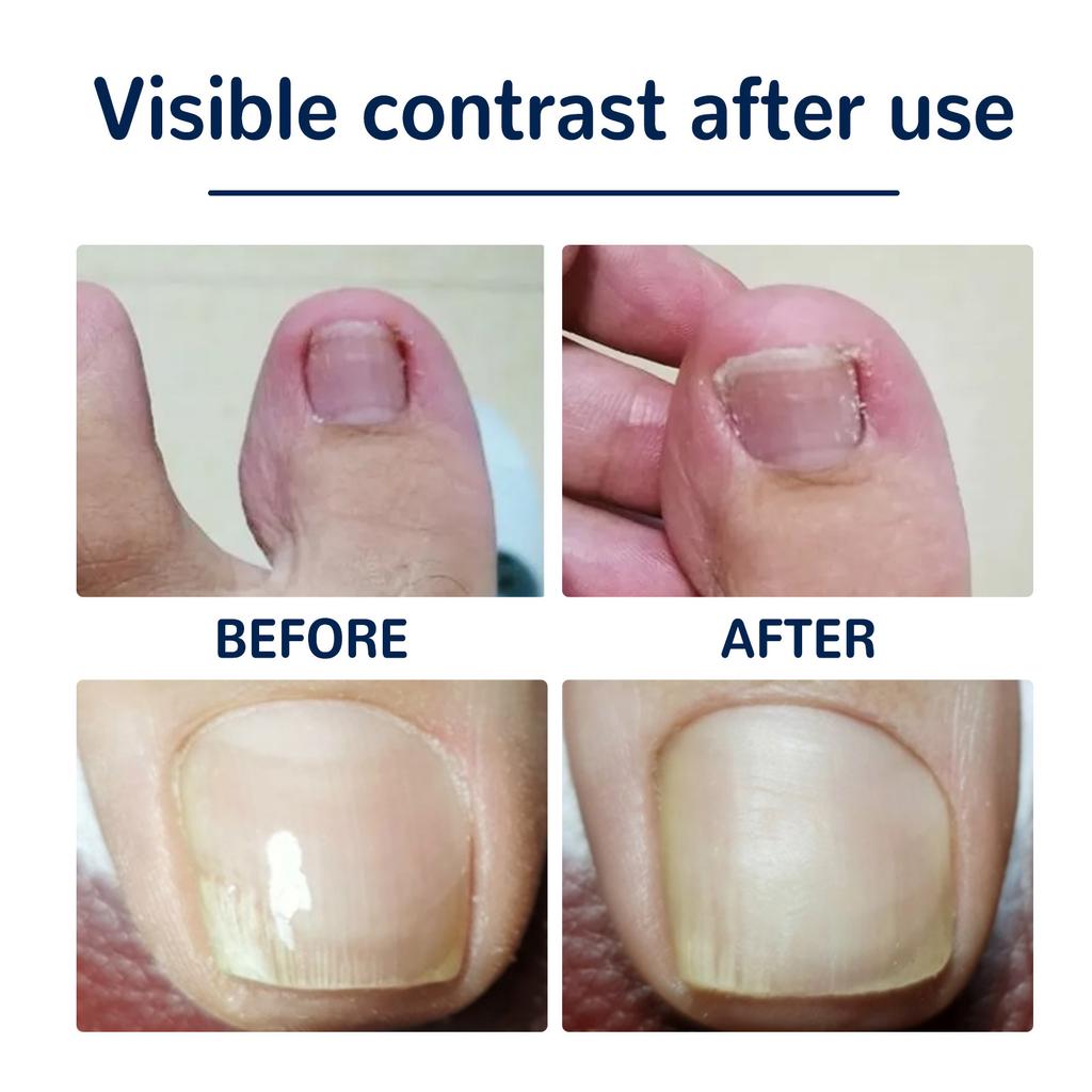 50 Stück Eingewachsener Zehennagel Aufkleber Starke Haftung Sicher Atmungsaktiv Einfach zu Verwenden Zehennagel Korrekturpflaster zur Zehennagelkorrektur
