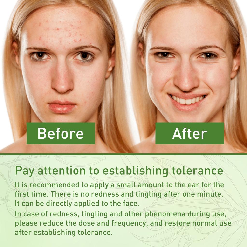 Acne Oil, Olive Oil, Acne Cleansing Oil, Acne Scar Lightening Olive Oil, Skin Care Oil ,30ML