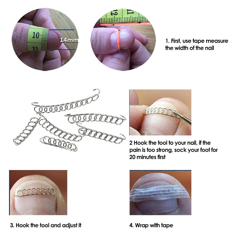 Ingrown Toe Nail Correction Wire Fixer Pedicure Paronychia Recover Toenails Corrector With Toe Correction Files Foot Care Tool