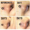 Piercing Healing Silicone Discs Flexible Anti Hyperplasia Saucer Prevents Irritation Inflammation Drilling Ear Stud Ring