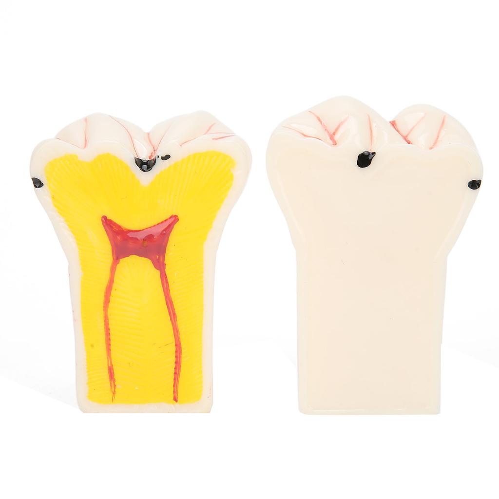 Dental Caries Model Tooth Decay Demonstration Model Simulation Detachable Teeth Model