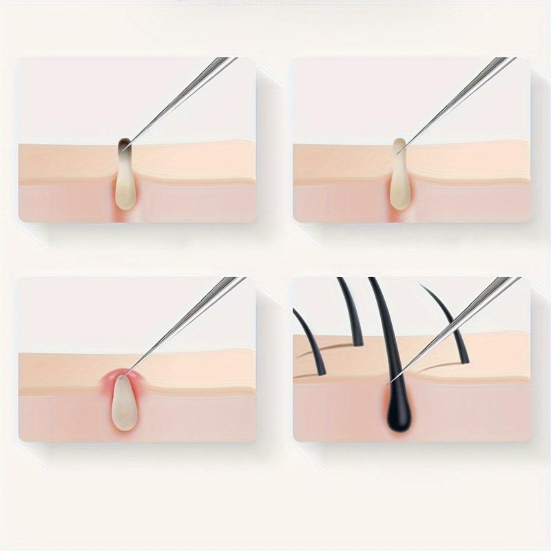 Ultra-fine Cell Pimples Blackhead Clip Tweezers Beauty Salon Remover Acne Needle Blackhead Deep Cleaner Clip Face Skin Care Tool