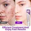 Crema Viso Acido Azelaico 15% Lenitiva Rossori Trattamento Acne Idratante Viso per Pelli Sensibili, Controllo Sebo, Schiarisce Macchie Scure