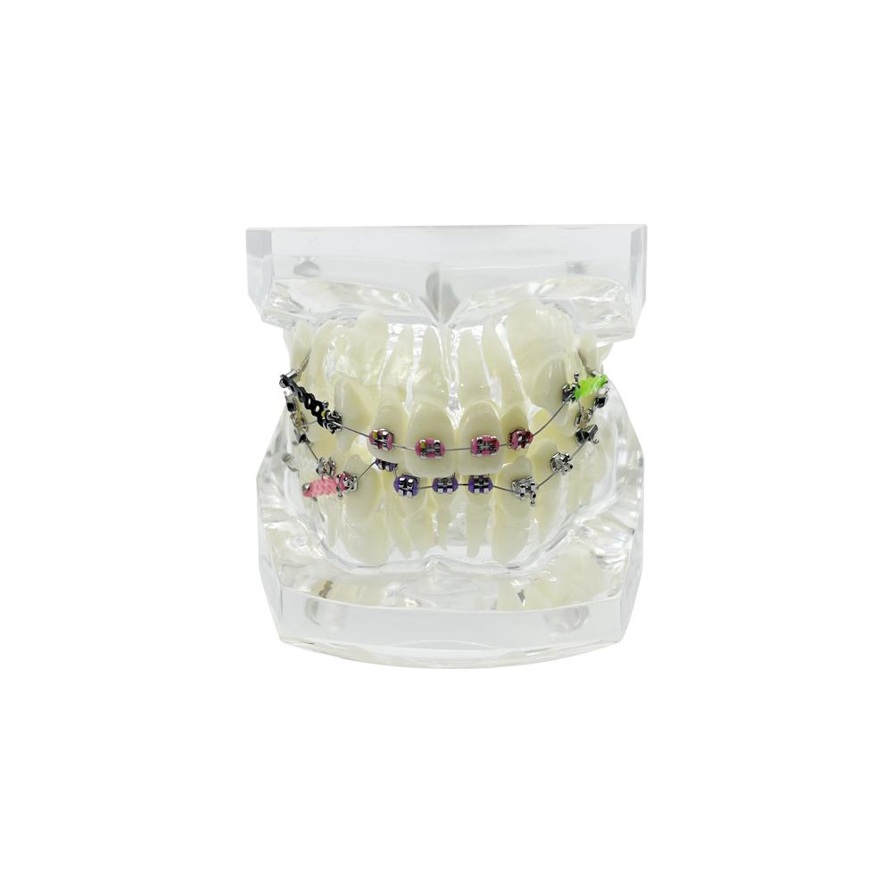Orthodontic Dental Model With Anchorage Nail Metal Bracket Ortho Teeth Model Transparent Typodont Jaw For Teaching Studying Demo