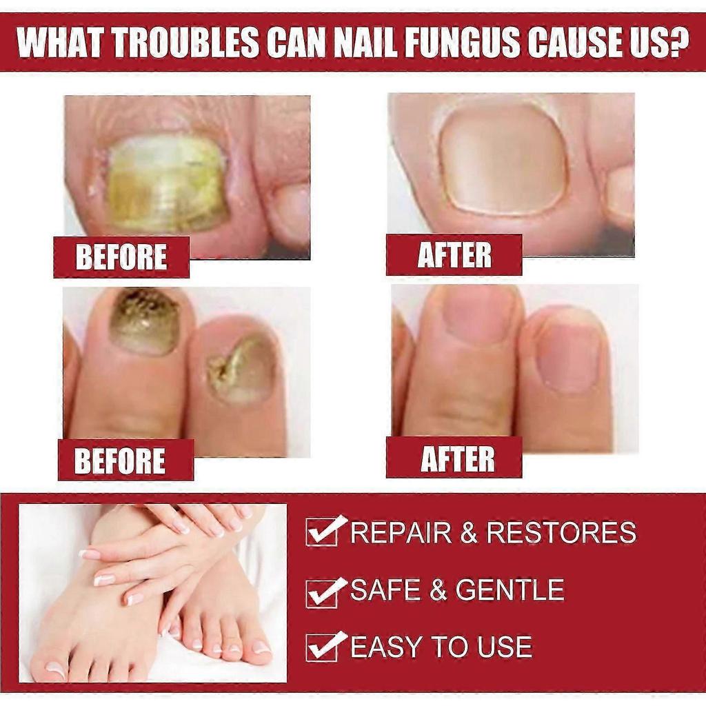 Effective Nail Repair  Moisturizing Solution for Healthy, FungusFree Nails