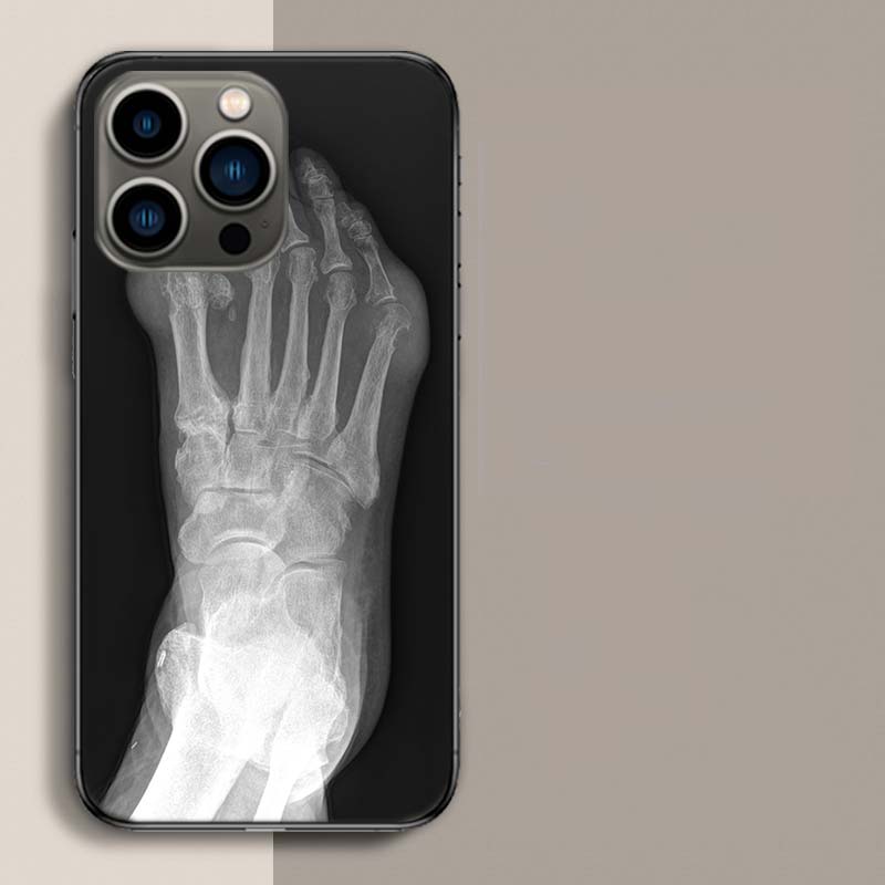 Herbst Röntgen Handknochen Handyhülle Für Apple Iphone 16E 16 17 Pro Max Air 15 Pro 14 Plus 12 13 Mini Hülle Niedliche Fundas Silico