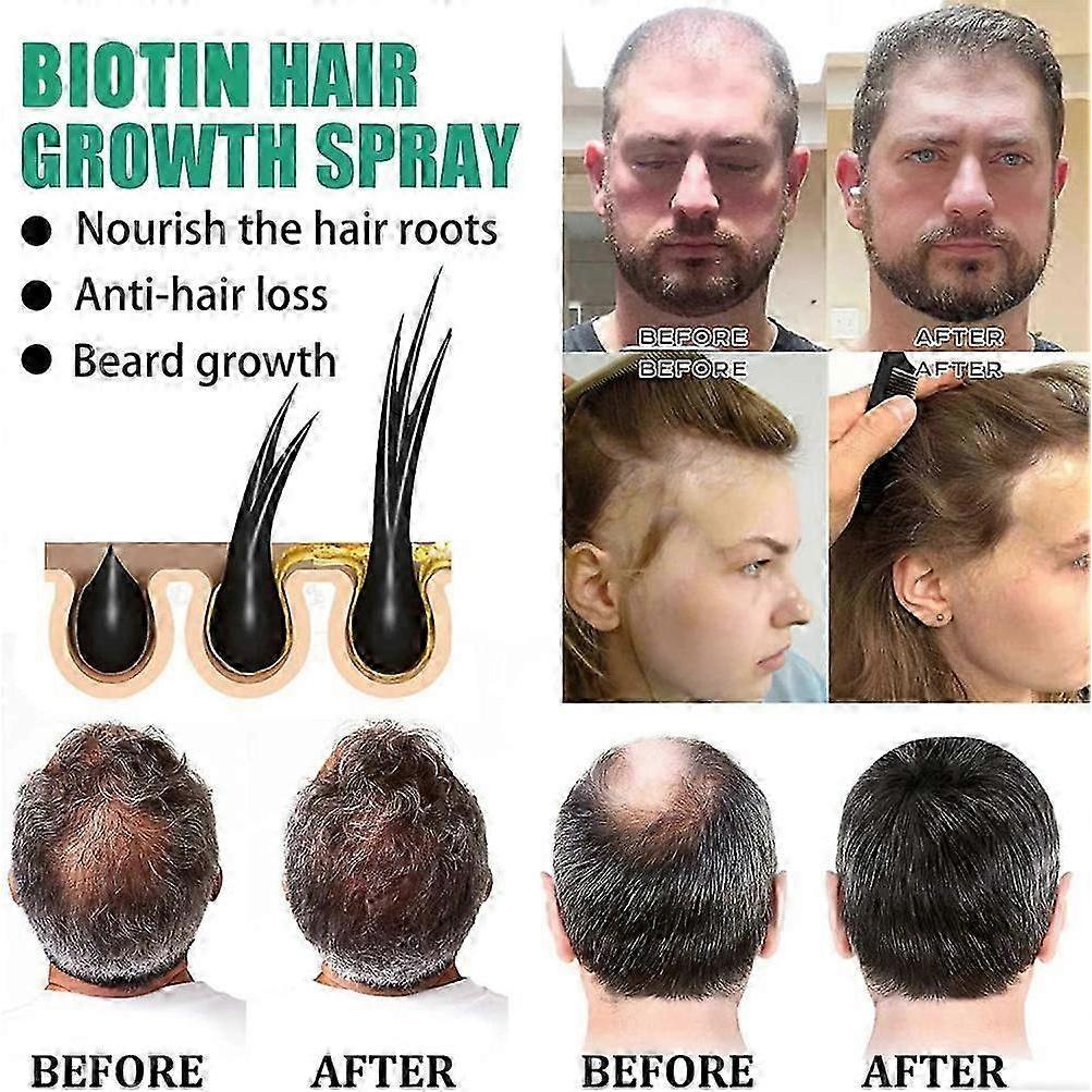 1-3x Biotin Hair Growth Spray Anti Hair Loss Fast Regrowth Scalp Treatment Serum 20ml for Men & Women