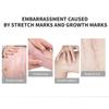 Removal Acne Scar Stretch Marks Cream Fat Scar  Treatment