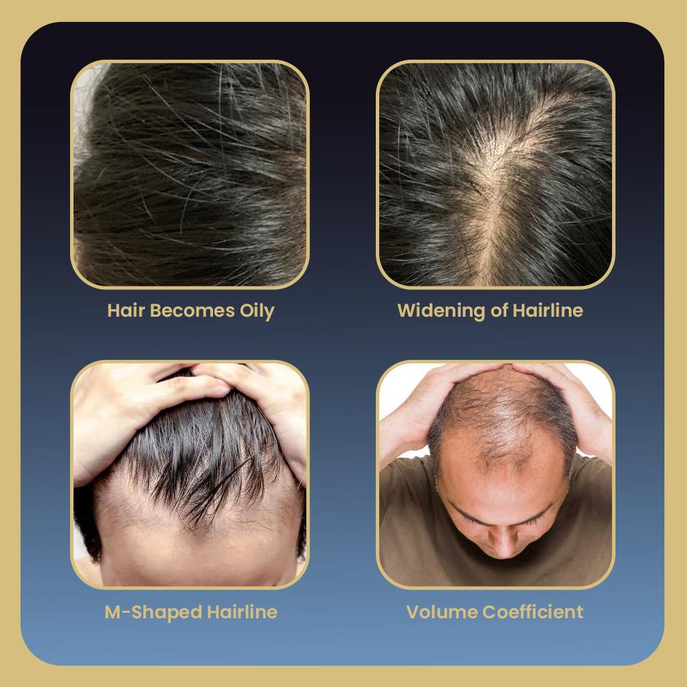 Sumifun 30 ML Ginger Hair Care Essence Spray,Hair Growth Essence Oil,Rapid Hair Growth Hair Nutrient Solution Scalp Care Repair Damaged Hair