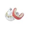 Dental Teeth Model With Implants Gold/Silver Bar Type Overdenture Restoration Treatment Typodont For Dentist Patient Teaching
