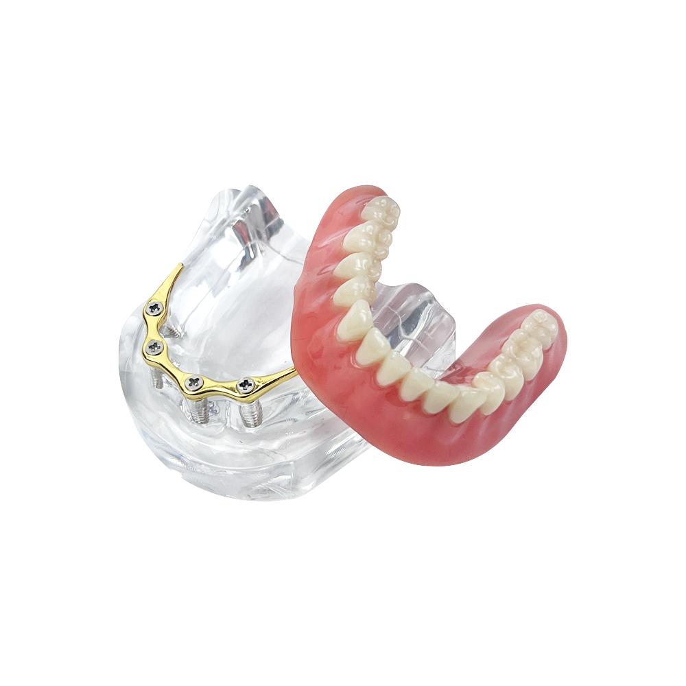 Dental Teeth Model With Implants Gold/Silver Bar Type Overdenture Restoration Treatment Typodont For Dentist Patient Teaching